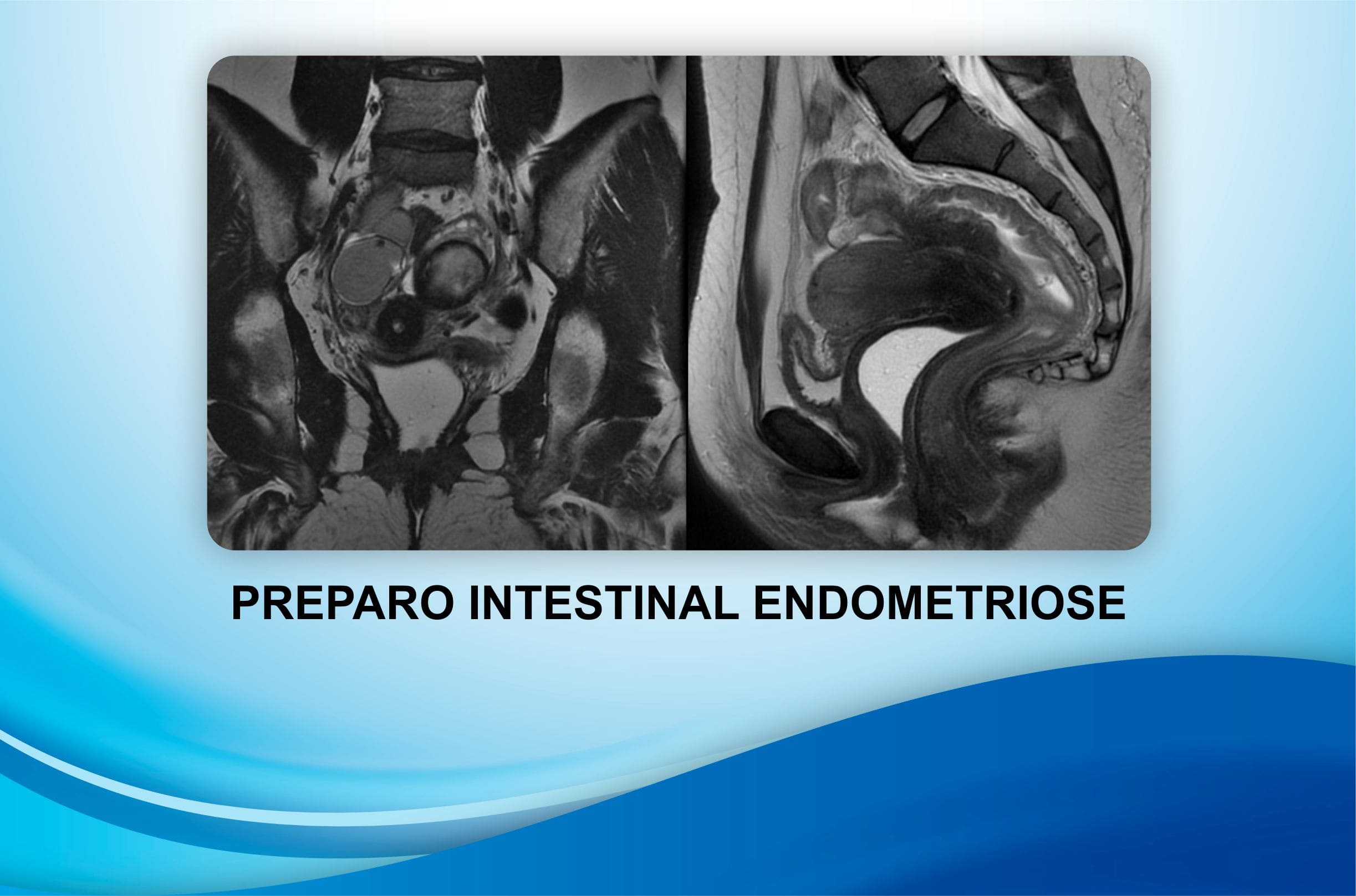 Preparo Intestinal Para Endometriose